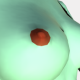 MG: nipple